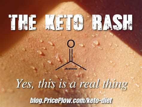 The Keto Rash Cure