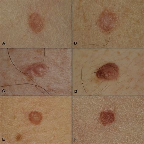 Histopathologic Clues For The Diagnosis Of Wiesner Nevus Journal Of
