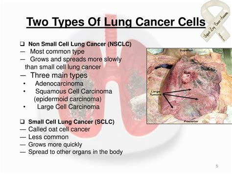 Ppt Lung Cancer Powerpoint Presentation Id 5790401