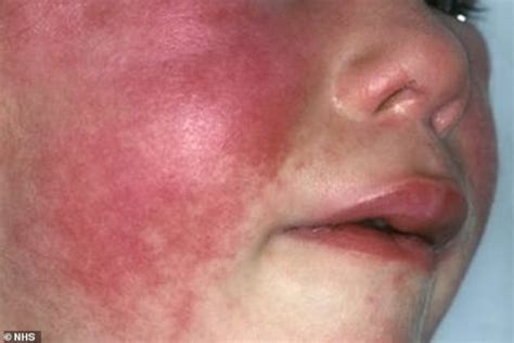 Uk Scarlet Fever Outbreak Is Highest In 50 Years Whoobly