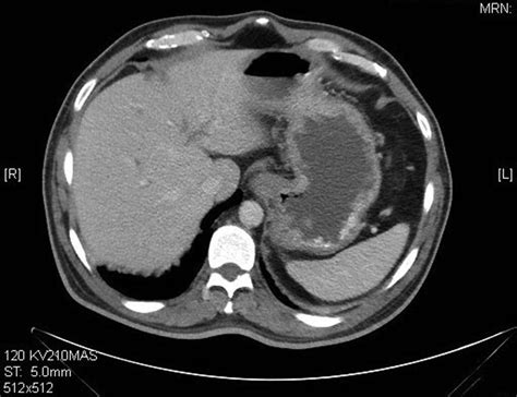 Axial Abdominal Computed Tomography With Contrast Shows Moderately
