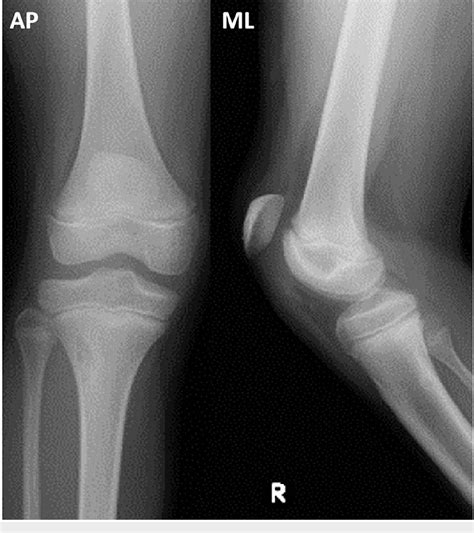 Figure 1 From Inferior Pole Sleeve Fracture Of The Patella In An