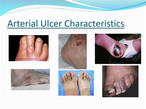 Ppt Ulcerations Due To Peripheral Vascular Disease Powerpoint