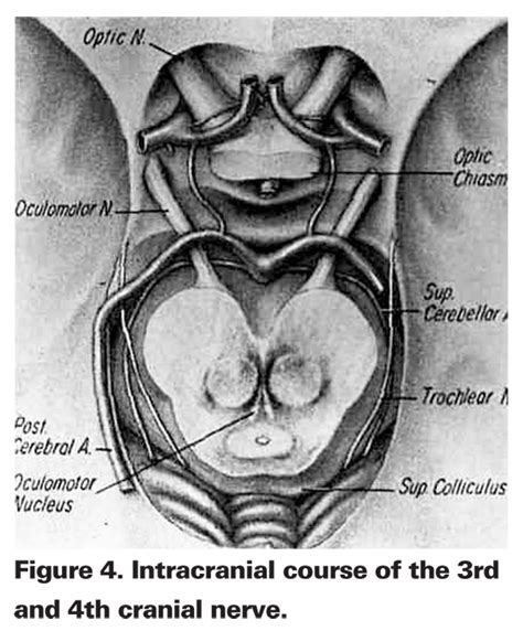 The underlying differential is extensive, but like the other cranial nerves, vasculopathic problems like diabetes and hypertension are common. Getting at the Root of Vertical Diplopia