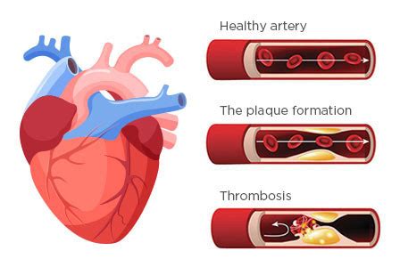 Types Of Cardiovascular Disease Canadian Heart Patient Alliance