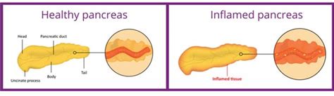 Pancreatitis Cancer Pancreas Pancreatitis Symptoms Pca