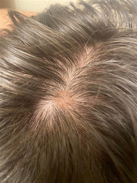 A Few Circular Raised Bumps On Scalp 20m Any Ideas On What These May
