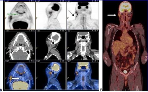 Primary Malignant Melanoma Of The Parotid Gland Combined 18f Fdgpetct