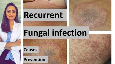 Recurrent Fungal Infection Causes How To Prevent Youtube
