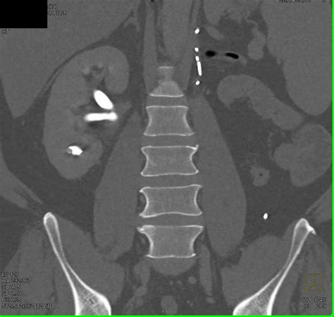 Stone In Right Renal Pelvis Kidney Case Studies Ctisus Ct Scanning