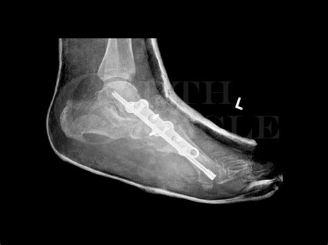 Charcot Foot Reconstruction