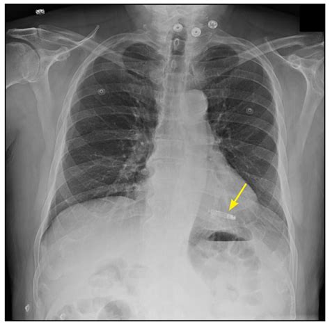 Leadless Pacing Available For Selected Patients Mayo Clinic