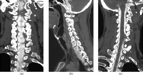 Figure 4 From Brachial Plexus Injury Diagnosis Of Nerve Root Avulsion