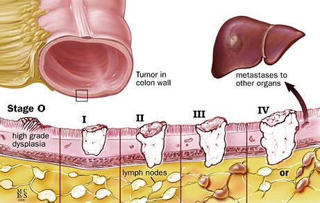 About two thirds of all colorectal tumours develop in the colorectal cancer is locally invasive but metastatic spread may be evident before local growth the dukes system is now gradually being replaced by the tumour/node/metastases (tnm) classification My Gastro Room: Staging of Colorectal Cancer