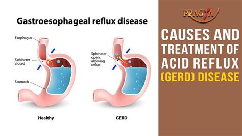 Watch Causes And Treatment Of Acid Reflux Gerd Disease Youtube