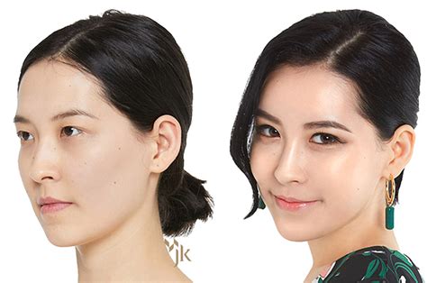 Korean Plastic Surgery Procedures Cheaper Than Retail Price Buy Clothing Accessories And