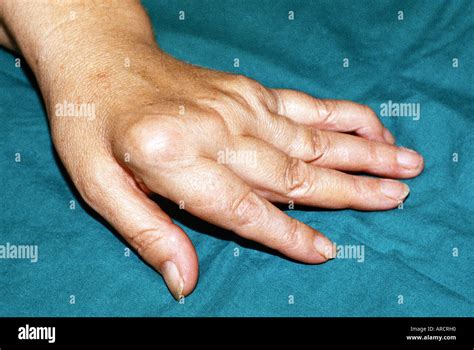 Rheumatoid Arthritis Of Hand With Ulnar Deviation Pho Vrogue Co