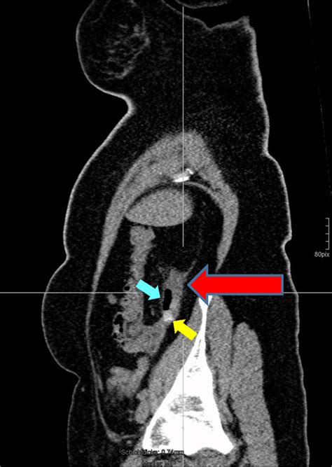 Classification Of Acute Appendicitis Caa Type 2b On Ct Gangrenous