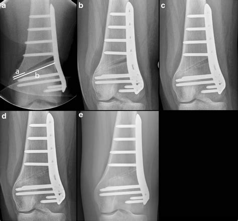 Distal Femoral Varus Osteotomy Results Of The Lateral Open Wedge My