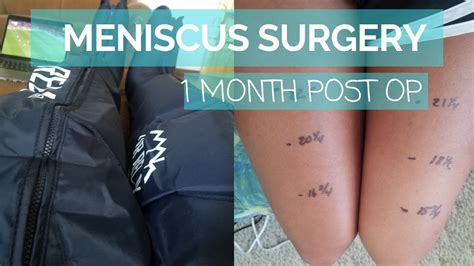 Meniscus Surgery Recovery Partial Meniscectomy Vlog 1 Month Post Op