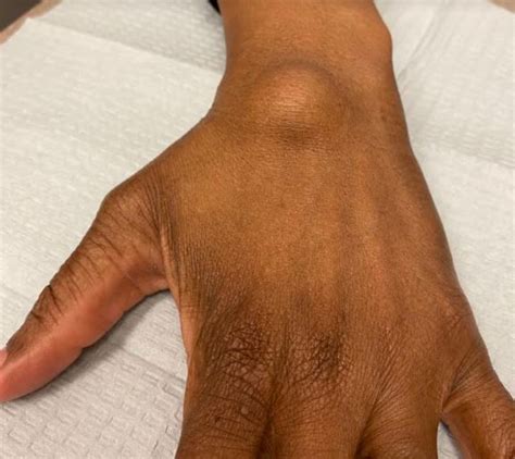 Can A Ganglion Cyst Disappear On Its Own Chris Mehl Kapsels