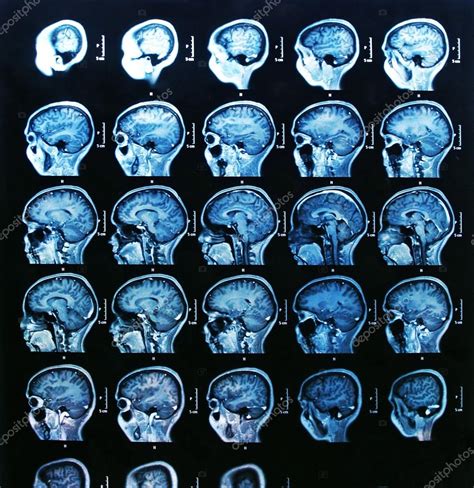 Mri Brain Scan Stock Photo Bunyos