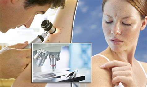 Skin Cancer News Powerful New Microscope Could Spot Deadly Melanoma