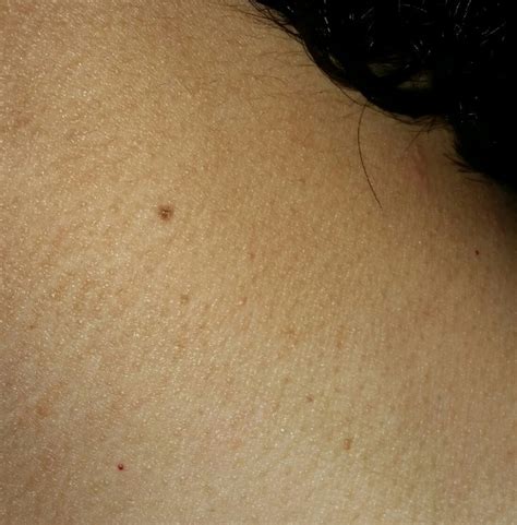 Spot On Skin On Neck Askdocs