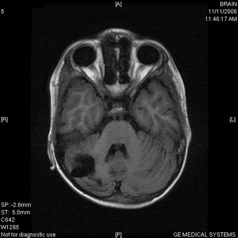 Bilateral Cerebellar Infarcts In A Child Eurorad