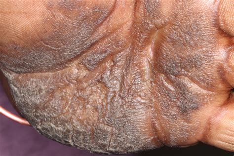 Thick Hyperkeratotic Plaques On The Palms And Soles Mdedge Dermatology