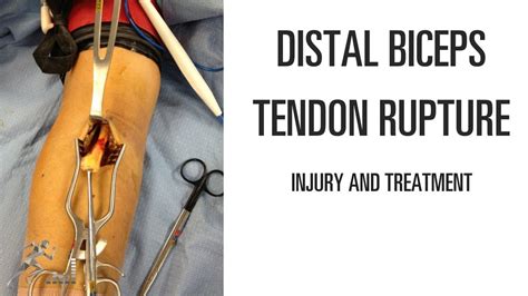 Distal Biceps Tendon Rupture Mechanism Of Injury And Treatment Youtube