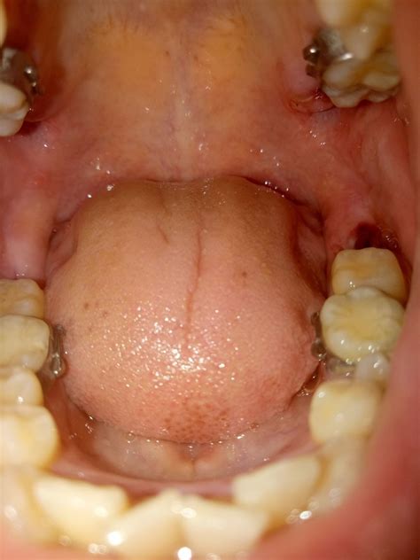 Floor Of Mouth Swollen After Tooth Extraction Review Home Decor