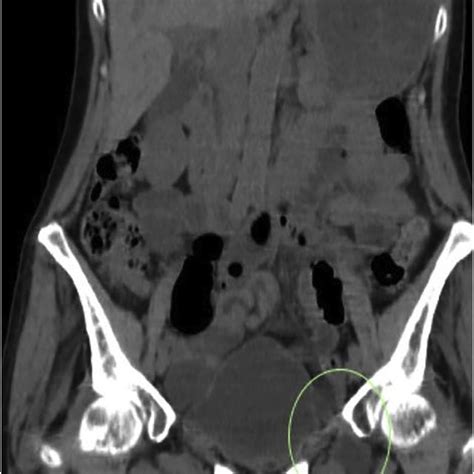 Intra Operative Imaging Of The Hernia Defect Within The Left Obturator