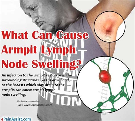 What Can Cause Armpit Lymph Node Swelling Lymph Nodes Armpit Lymph Images And Photos Finder