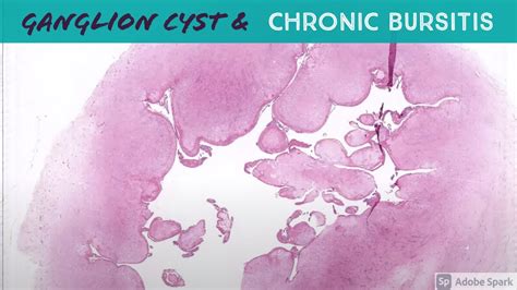 Ganglion Cyst Vs Chronic Bursitis 5 Minute Pathology Pearls Youtube