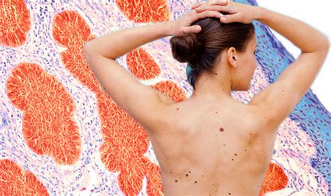 The warning signs of skin cancer. Flu jab: Can you have the vaccine when you have a cold ...