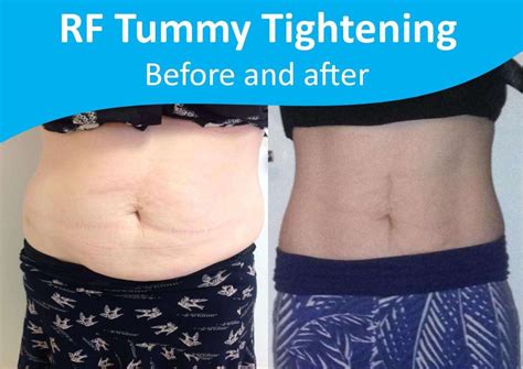 Rf Skin Tightening Body Clearskin