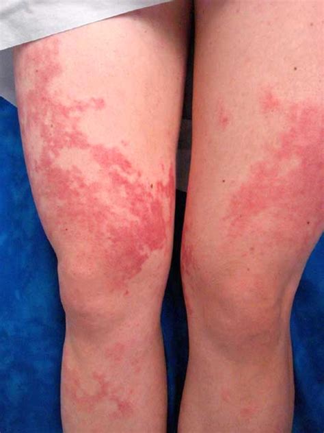 Also feel free to crosspost the best submissions from there here. VIRTUAL GRAND ROUNDS IN DERMATOLOGY 2.0: 35 yo woman with ...