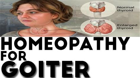 Homoeopathic Remedies For Goitre