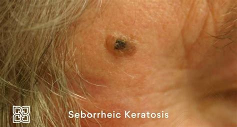 Seborrheic Keratosis Edmonton Dermatology │ Nakatsui Dermasurgery