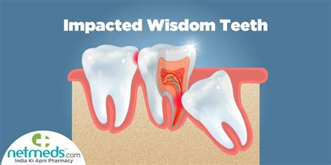 Impacted Wisdom Teeth Causes Symptoms And Treatment