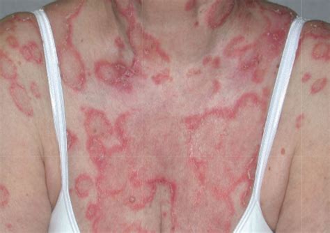 Acd A Z Of Skin Cutaneous Lupus Erythematosus