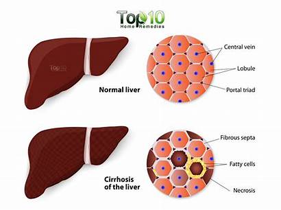 Liver Coffee Cirrhosis Cups Blood Tissue Disease