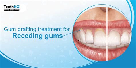 Gum Grafting Treatment For Receding Gums Toothhq Dental Specialist