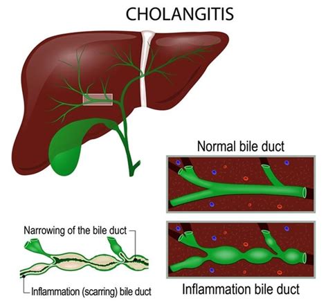 What Is Acute Cholangitis Human Digestive System Cholelithiasis