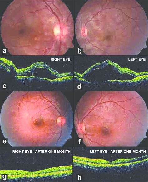 A B Fundus Photograph Of Both Eyes Showing Multiple Serous Retinal