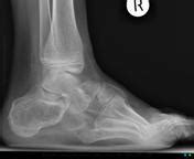 Clubfoot can have postural and structural characteristics that are classified by the pirani and demeglio scales. Rocker bottom foot | Radiology Reference Article ...