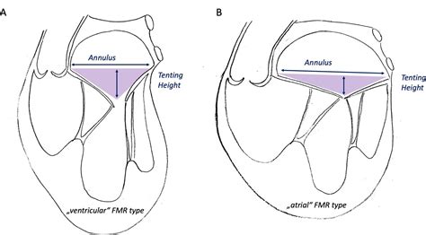 Predicting Clinical Outcome By Indexed Mitral Valve Tenting In