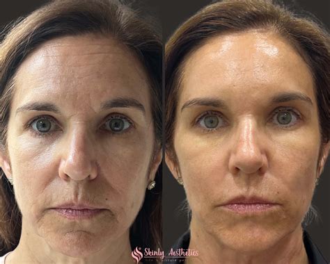 Cheek Fillers Before And After Results At Skinly