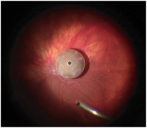 A Dislocated Crystalline Lens In A Patient With Marfan Syndrome Marfan Syndrome Medical Syndrome